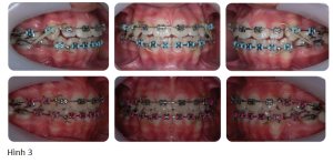 Phân tích case: Niềng răng thành công cho bệnh nhân bị hô 2 hàm, có nhổ 4 răng hàm nhỏ