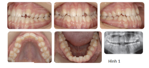 Phân tích case: Chỉnh nha tiền phẫu thuật cho bệnh nhân bị móm, hàm dưới đưa ra trước và lệch trái