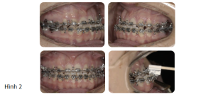 Phân tích case: Chỉnh nha tiền phẫu thuật cho bệnh nhân bị móm, hàm dưới đưa ra trước và lệch trái