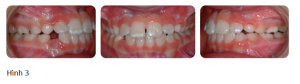 Phân tích case: Hình ảnh ca niềng thành công cho bệnh nhân bị móm, cắn chéo răng rửa