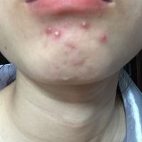 Cách chữa mụn nổi ở cằm Cách chữa mụn nổi ở cằm