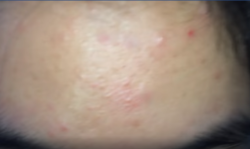 Mặt đầy mụn và vết thâm không biết khắc phục thế nào?