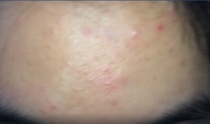 Mặt đầy mụn và vết thâm không biết khắc phục thế nào?