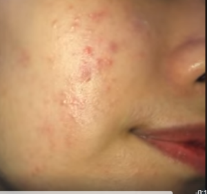 Mặt đầy mụn và vết thâm không biết khắc phục thế nào?