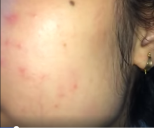 Mặt đầy mụn và vết thâm không biết khắc phục thế nào?