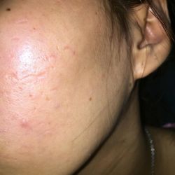 Da mặt như một chảo dầu phải làm thế nào?