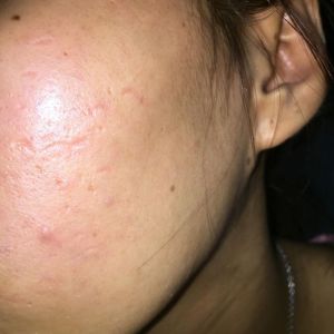 Da mặt như một chảo dầu phải làm thế nào?