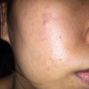 Da mặt như một chảo dầu phải làm thế nào?