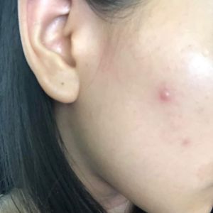 Có nên nặn mụn không?