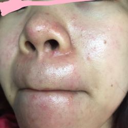 Cứu vớt làn da bị mụn nhỏ, mụn đầu đen, mụn đầu trắng?