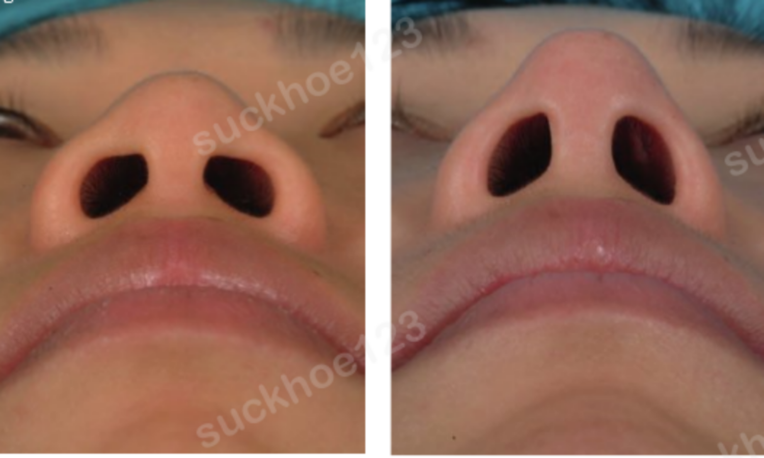 Dáng đầu mũi trước và sau phẫu thuật nâng mũi cấu trúc bằng sụn sườn