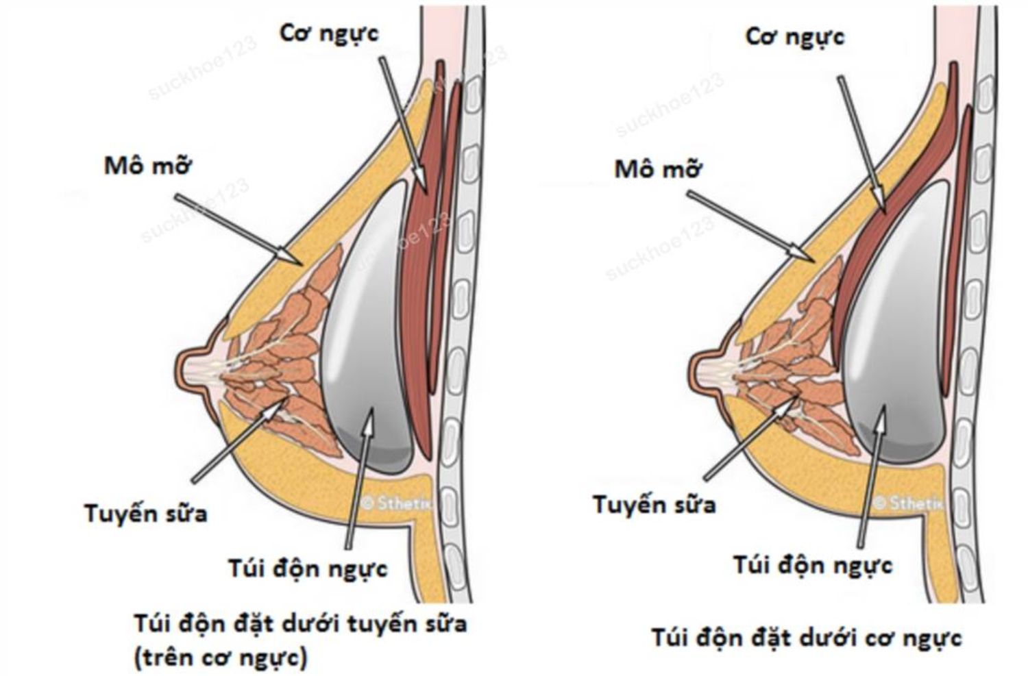 Vị trí khoang chứa túi độn ngực: trên hay dưới cơ