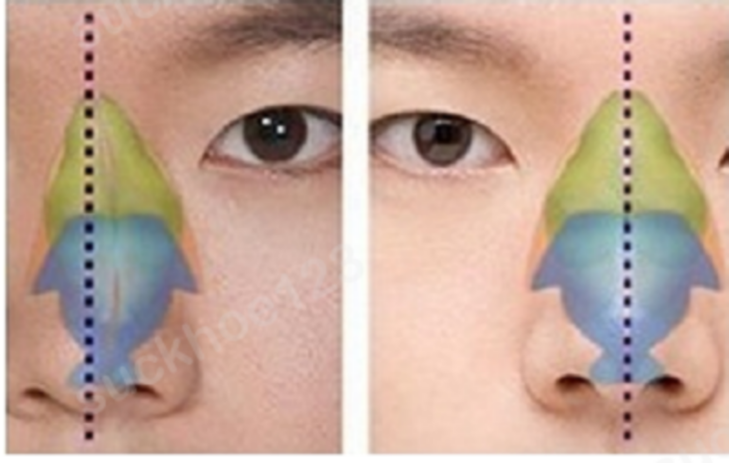 đầu mũi lệch1