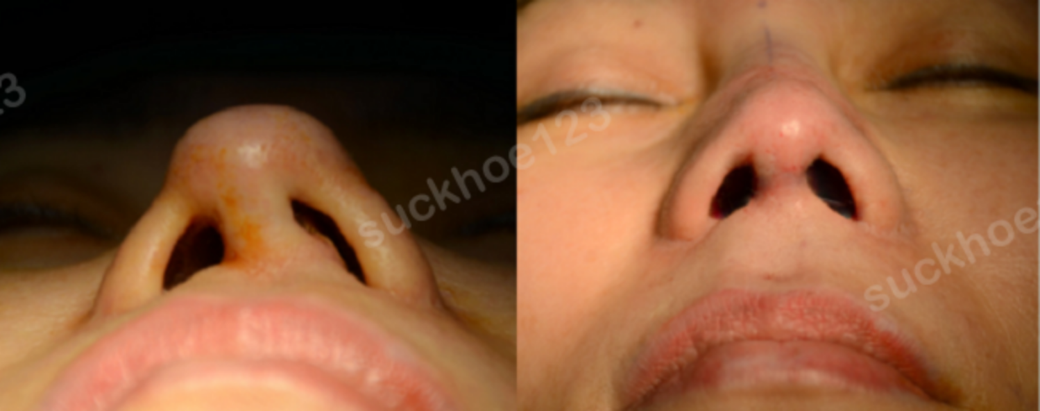 đầu mũi lệch2