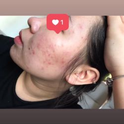 Cách trị mụn cho da đổ dầu?