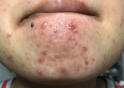 Giải cứu da mặt dùng kem trộn