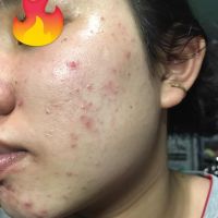 Giải cứu da mặt dùng kem trộn