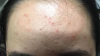 Giải cứu da mặt dùng kem trộn