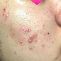 Giải cứu da mặt dùng kem trộn