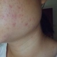 Chu trình skincare cho da mặt mụn ẩn, mụn viêm, mụn do nội tiết? Chu trình skincare cho da mặt mụn ẩn, mụn viêm, mụn do nội tiết?