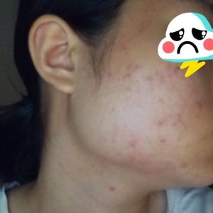 Chu trình skincare cho da mặt mụn ẩn, mụn viêm, mụn do nội tiết?