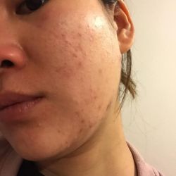 Tư vấn sản phẩm trị mụn, mụn ẩn, mụn đầu đen, lỗ chân lông,...