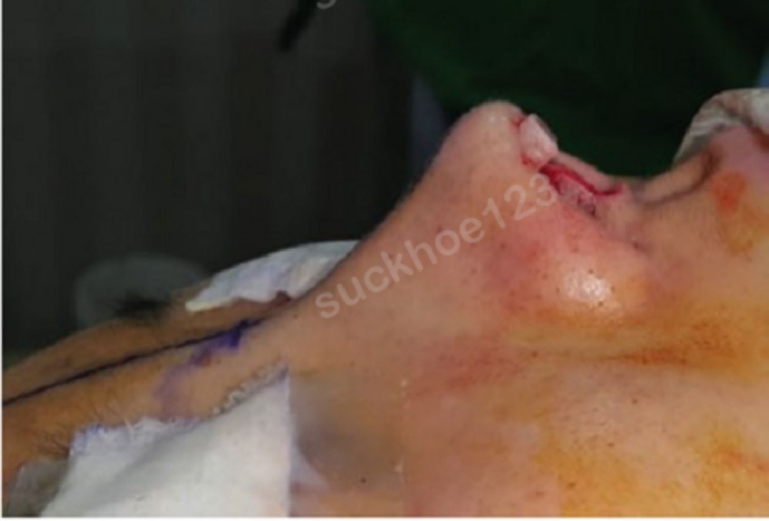 hình 10 chèn miếng độn