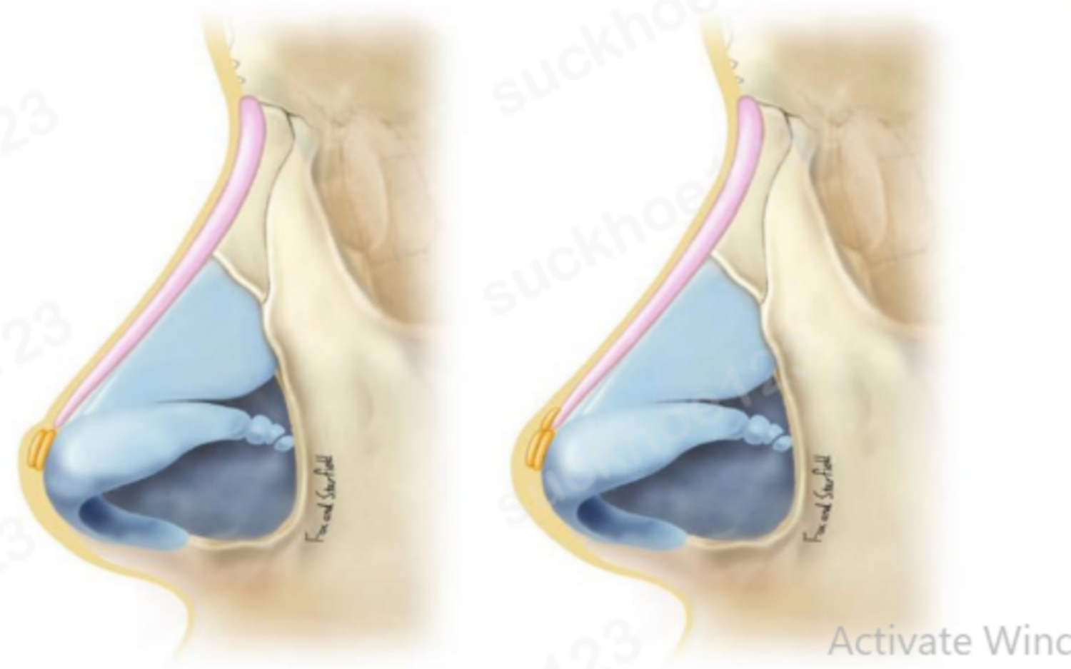 hình 2 bọc đầu mũi
