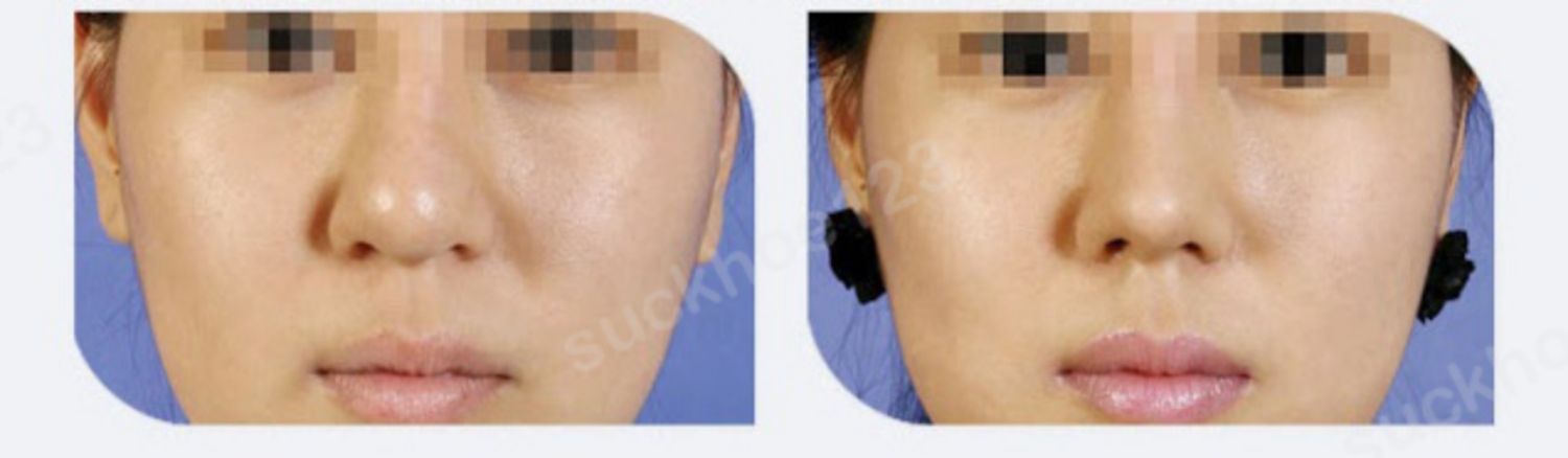 hình 3 mũi củ hành