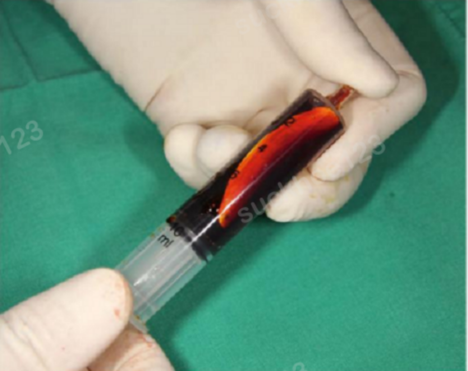 hình 5 xử lý sụn trước PT