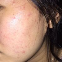 Cách sử dụng sản phẩm hiệu quả nhất cho da mụn? Cách sử dụng sản phẩm hiệu quả nhất cho da mụn?