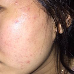 Cách sử dụng sản phẩm hiệu quả nhất cho da mụn?