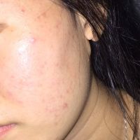 Cách sử dụng sản phẩm hiệu quả nhất cho da mụn? Cách sử dụng sản phẩm hiệu quả nhất cho da mụn?