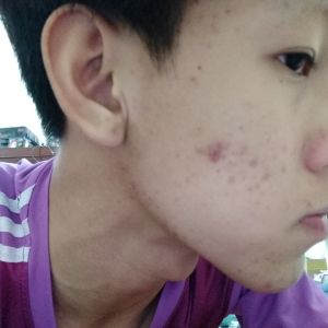 Tìm sản phẩm trị mụn nhanh