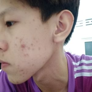 Tìm sản phẩm trị mụn nhanh