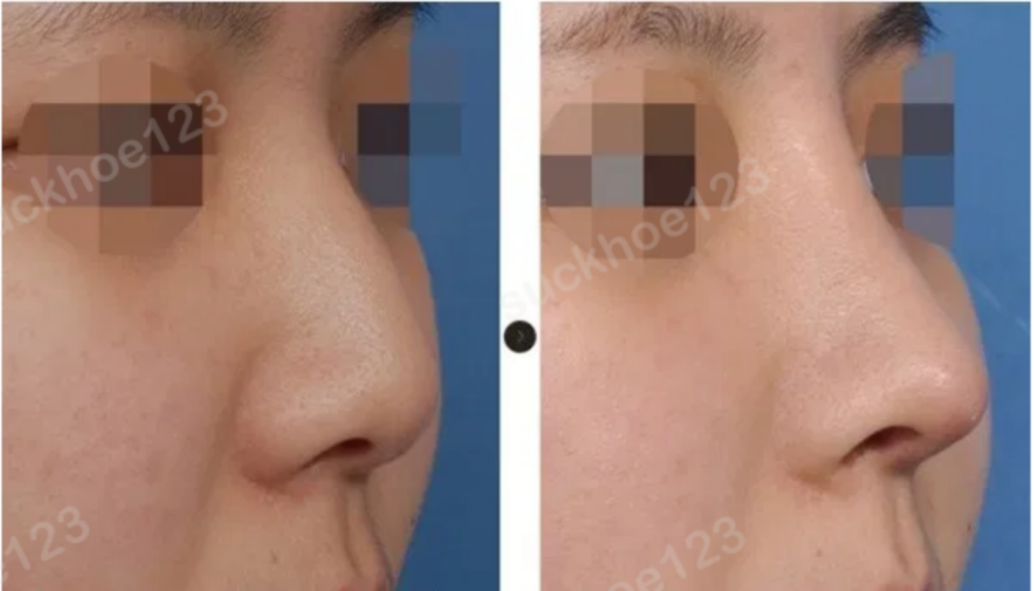 kết quả tạo hình đầu mũi