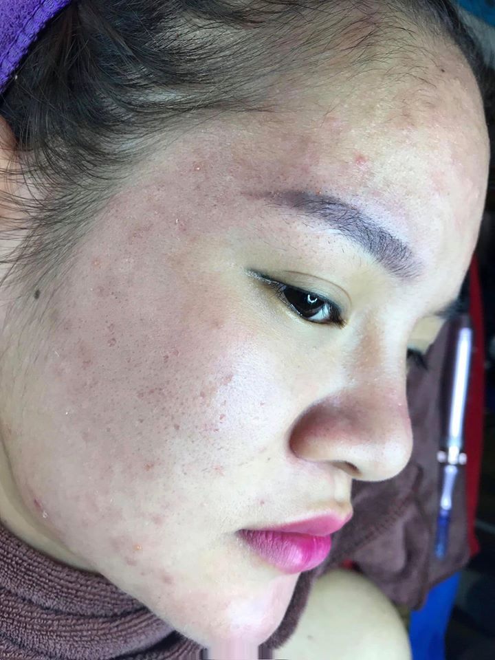 Chia sẻ quá trình trị mụn của Lê