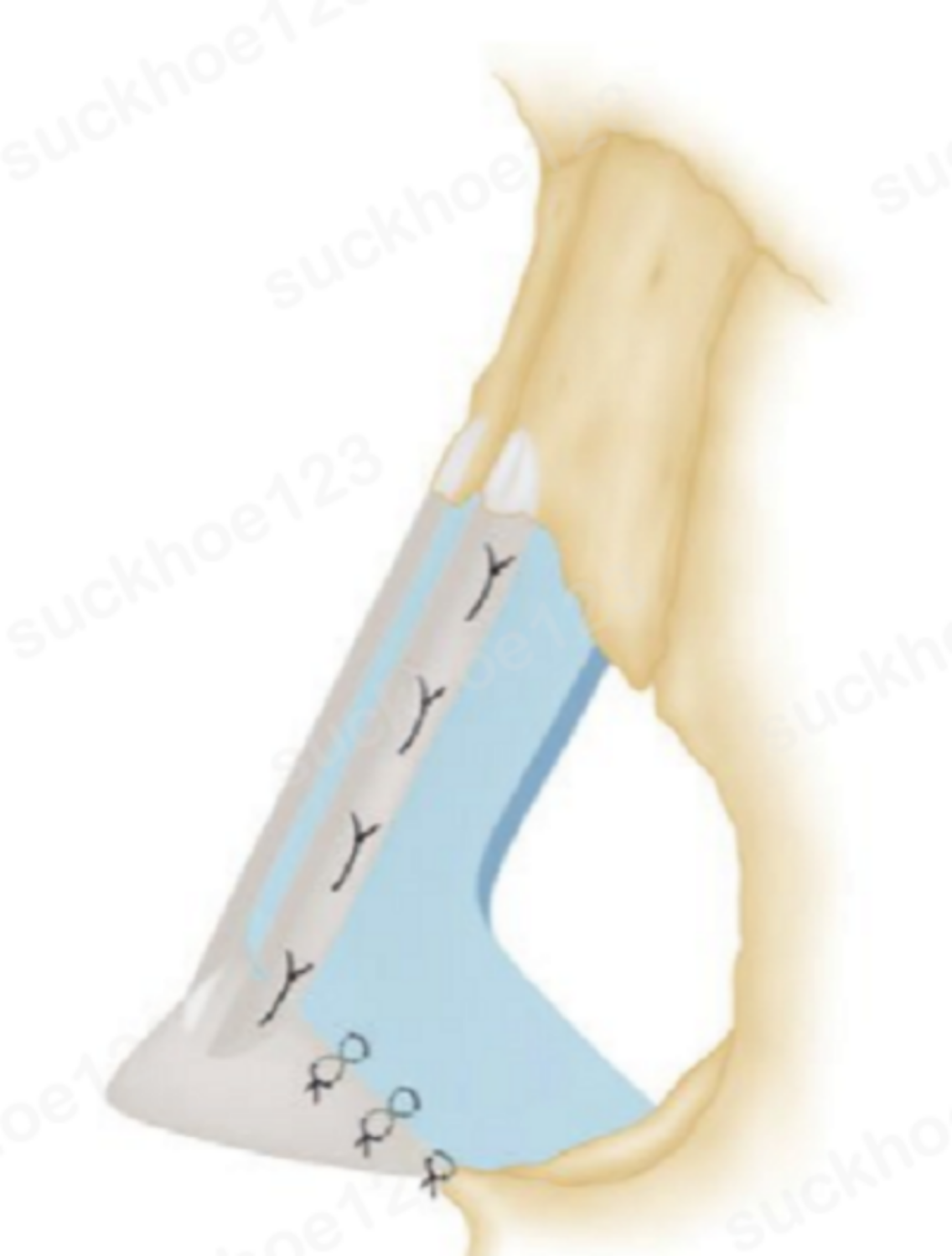 miếng ghép mở rộng vách ngăn loại nối 2