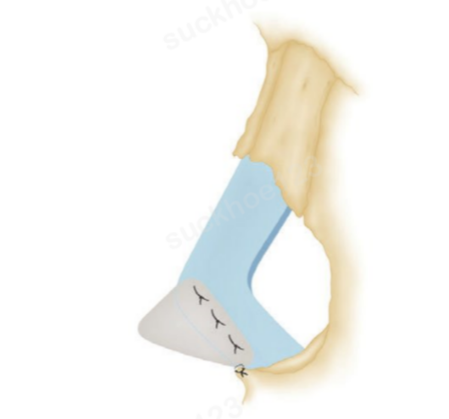 miếng ghép mở rộng vách ngăn loại xếp chồng 1