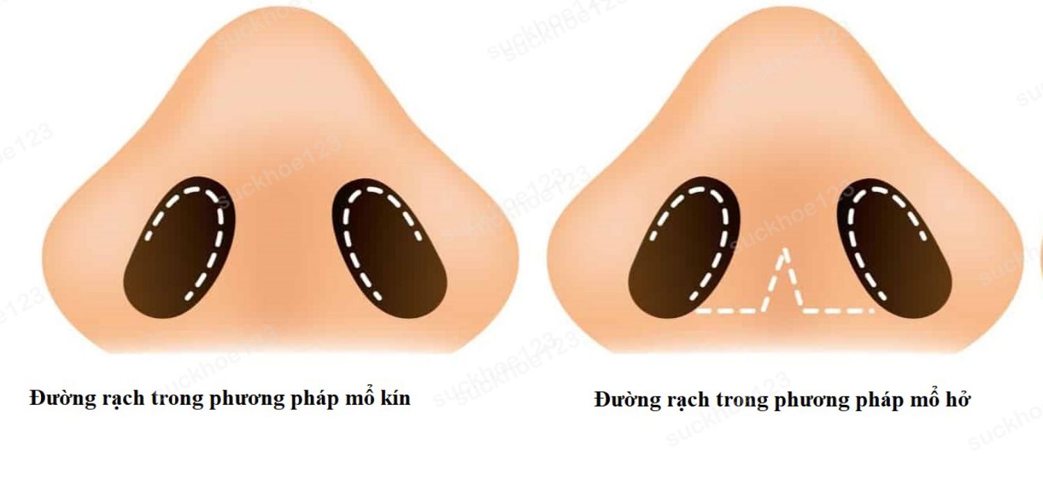 mổ hở