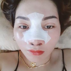 Mũi sửa lại nhưng thấy xấu hơn