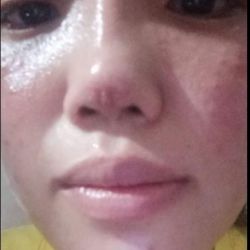 Tháo mũi 2 tháng đầu mũi vẫn cứng, sưng và lõm