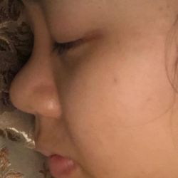 Tháo mũi 3 ngày bị sưng cứng và co hếch đầu mũi, bao lâu sẽ hết?