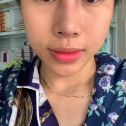 Mũi làm được 7 tháng tự nhiên sưng