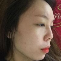 Mũi nhỏ và hếch nên nâng kiểu gì?