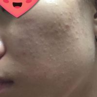 Dùng aha crosrx có đẩy mụn được không? Dùng aha crosrx có đẩy mụn được không?