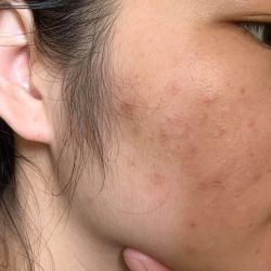 Nên dùng toner, tinh chất trị mụn nào để trị hết mụn ẩn?