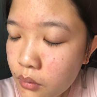 Nguyên nhân và cách chữa trị mụn có đầu trắng Nguyên nhân và cách chữa trị mụn có đầu trắng