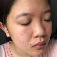 Nguyên nhân và cách chữa trị mụn có đầu trắng Nguyên nhân và cách chữa trị mụn có đầu trắng