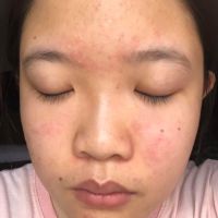 Nguyên nhân và cách chữa trị mụn có đầu trắng Nguyên nhân và cách chữa trị mụn có đầu trắng